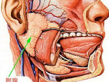 慢性化脓性腮腺炎