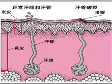 多汗症