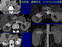 肾动脉瘤