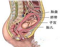 羊膜腔感染综合征