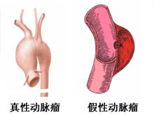 主动脉假性动脉瘤