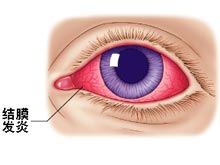 结膜炎