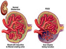 局灶性节段性肾小球硬化