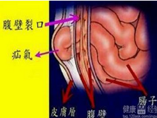 小儿盘肠气痛