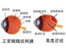 近视