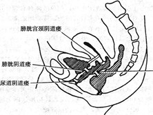 尿瘘