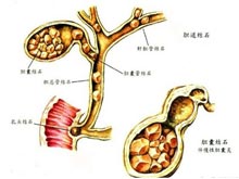 胆结石