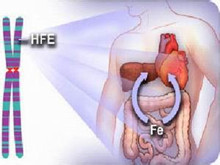 遗传性血色病