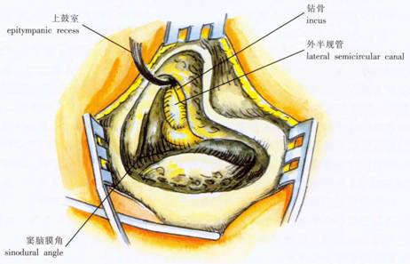 急性化脓性乳突炎