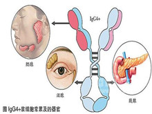 原发免疫性疾病相关的淋巴增殖性疾病