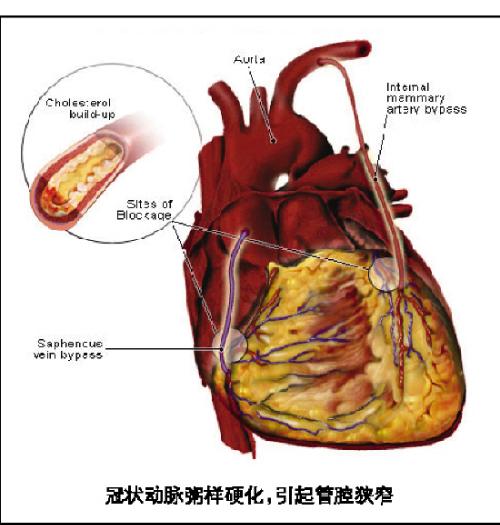 急性冠脉综合征