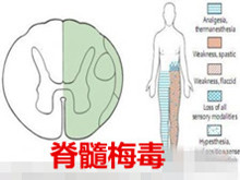 脊髓梅毒