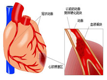 急性心肌梗塞