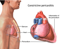 急性心包炎