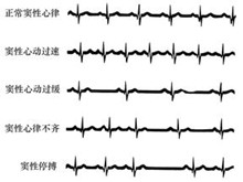 窦性停搏