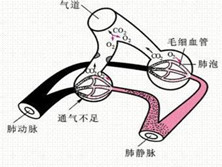 肺泡通气低下综合征