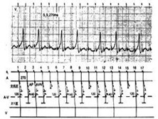 房性心动过速伴房室传导阻滞