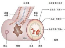 假性肠梗阻