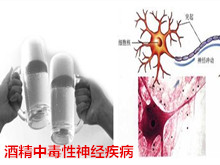 酒精中毒性神经疾病