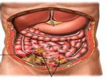 急性化脓性弥漫性腹膜炎