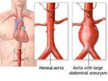 炎症性腹主动脉瘤