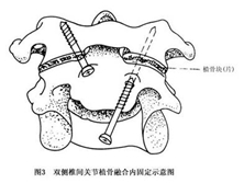 枢椎齿突骨折