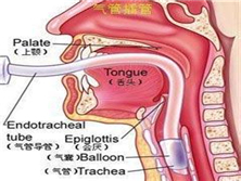 医源性气管及主支气管损伤