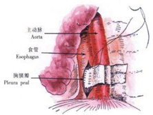 异物性食管穿孔