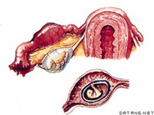 输卵管妊娠