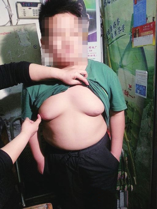 男性乳房肥大症