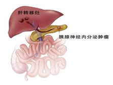 胰高血糖素瘤