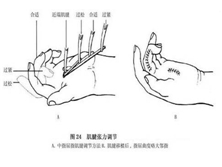 手部屈指肌腱损伤