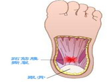 松弛性跖痛症