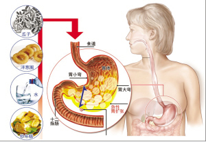 急性胃扩张