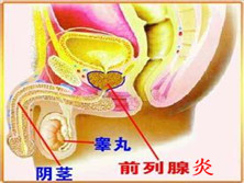 慢性细菌性前列腺炎