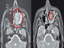 鼻咽肉瘤