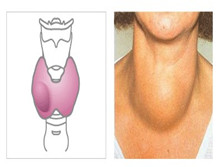 甲状腺功能正常的甲状腺肿大