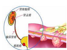 泌尿系肿瘤