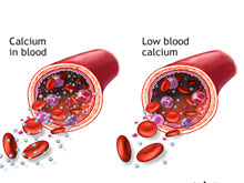 低钙血症