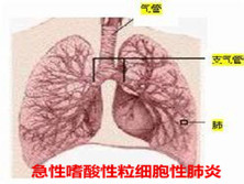 急性嗜酸性粒细胞性肺炎