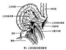 乙状结肠间疝