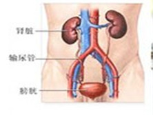 肾盏憩室