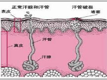 下丘脑多汗症