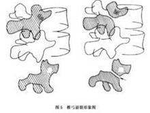腰部峡部崩裂和脊椎滑脱