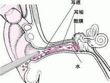 耳真菌病