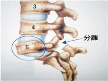 腰椎小关节不稳症