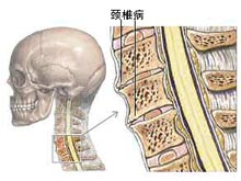 颈椎病
