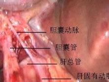 腹卒中综合征