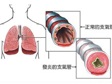 急性支气管炎