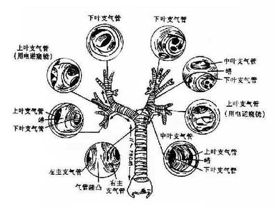 急性气管支气管炎